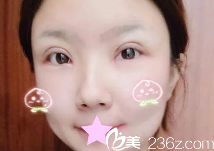 切开双眼皮第七天拆线后图片