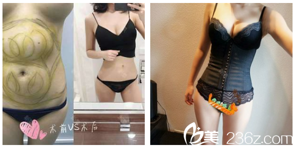 广州美莱王志军腰腹部抽脂案例对比图