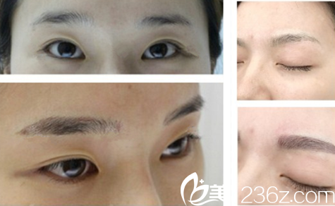 擅长半的路阿蓝医生案例对比图 擅长半的路阿蓝医生案例对比图