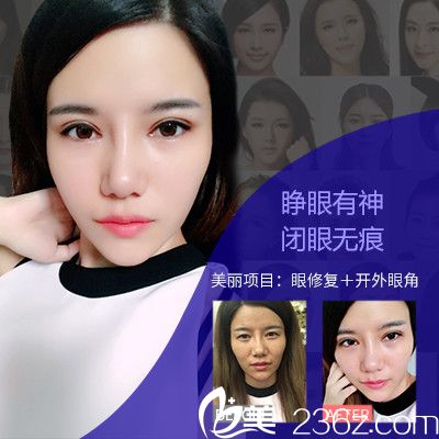 广州美莱黄泽春双眼皮失败修复和开外眼角案例对比图 广州美莱黄泽春双眼皮失败修复和开外眼角案例对比图