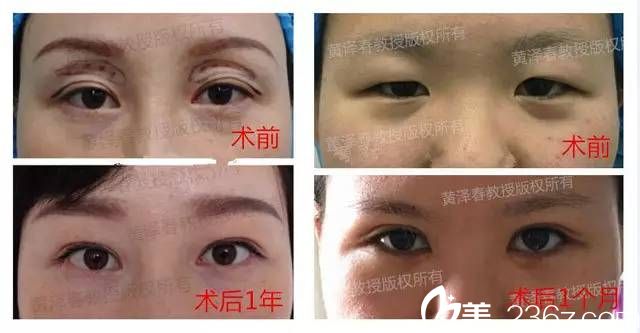 广州美莱黄泽春做双眼皮的图片 广州美莱黄泽春做双眼皮的图片