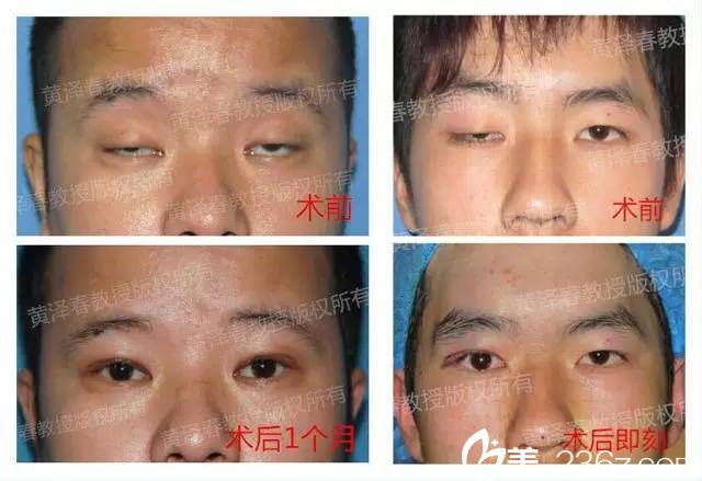 广州美莱黄泽春修复双眼皮图片 广州美莱黄泽春修复双眼皮图片