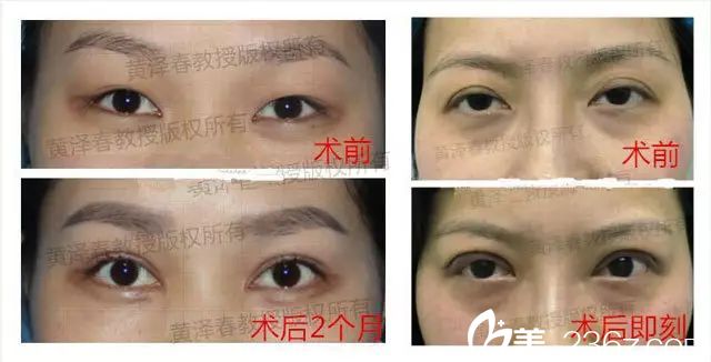 广州美莱黄泽春修复双眼皮案例 广州美莱黄泽春修复双眼皮案例