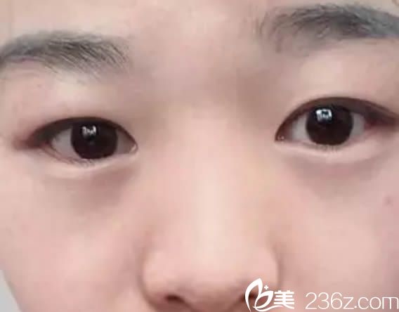 在厦门欧菲整形医院做双眼皮术前照 在厦门欧菲整形医院做双眼皮术前照