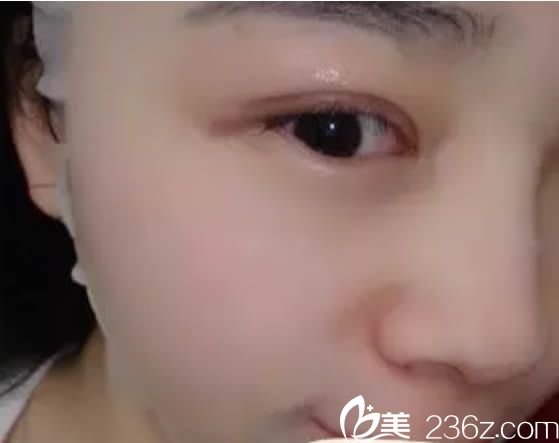 想了解厦门欧菲和美莱哪个整形好的亲们 可以借鉴我在欧菲做双眼皮和隆鼻的案例效果