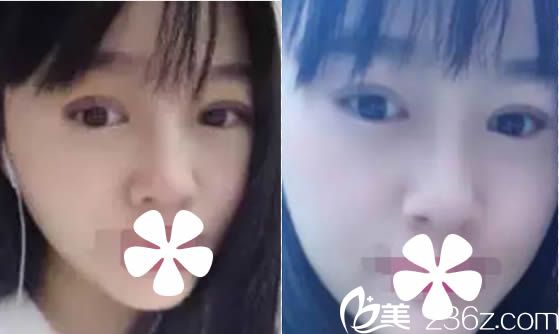 假体隆鼻和切开双眼皮15天 假体隆鼻和切开双眼皮15天