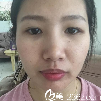 广州美莱黄泽春双眼皮失败修复案例术前 广州美莱黄泽春双眼皮失败修复案例术前