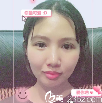 找黄泽春做完双眼皮修复两周图片 找黄泽春做完双眼皮修复两周图片