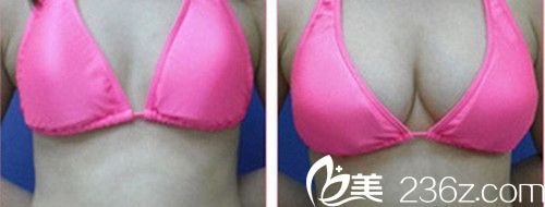 韩国美特乐整形医院隆胸手术案例 韩国美特乐整形医院隆胸手术案例