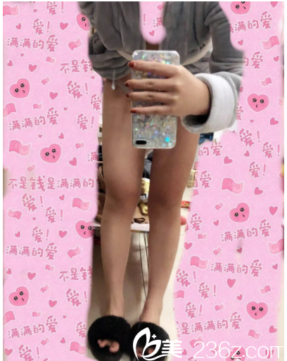大腿吸脂术后一个月效果图
