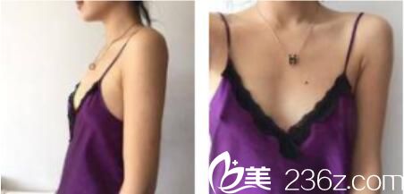 韩国朴贤整形外科朴贤自体脂肪隆胸真人案例术前照 韩国朴贤整形外科朴贤自体脂肪隆胸真人案例术前照