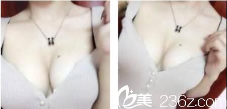 韩国朴贤整形外科朴贤自体脂肪隆胸真人案例术后一个月 韩国朴贤整形外科朴贤自体脂肪隆胸真人案例术后一个月