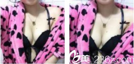 韩国朴贤整形外科朴贤自体脂肪隆胸真人案例术后三个月 韩国朴贤整形外科朴贤自体脂肪隆胸真人案例术后三个月