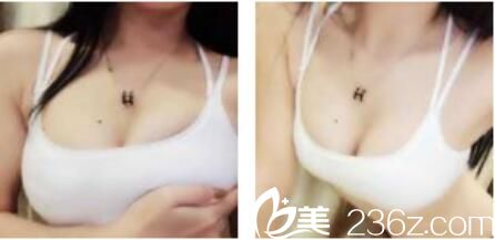 韩国朴贤整形外科隆胸技术怎么样？看朴贤一年前为我做的自体脂肪隆胸现在维持的特别好