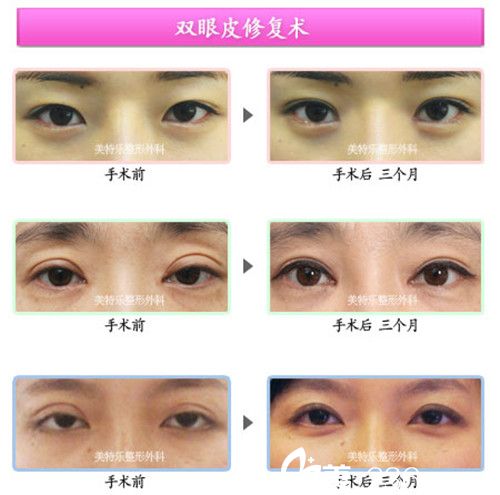 洪政槿院长双眼皮修复手术案例 洪政槿院长双眼皮修复手术案例