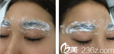 术后微肿敷着消炎药膏