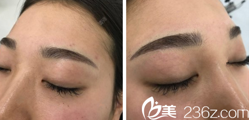 崔贵东院长做的半纹眉恢复7天