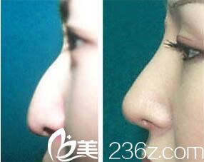 姜洪哲鼻部整形真人案例对比