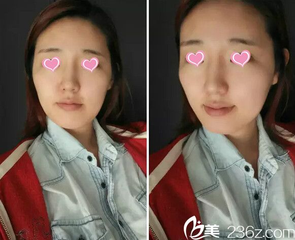 手术前照片 手术前照片