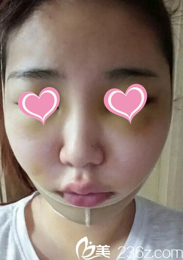 颧骨手术后1天 颧骨手术后1天