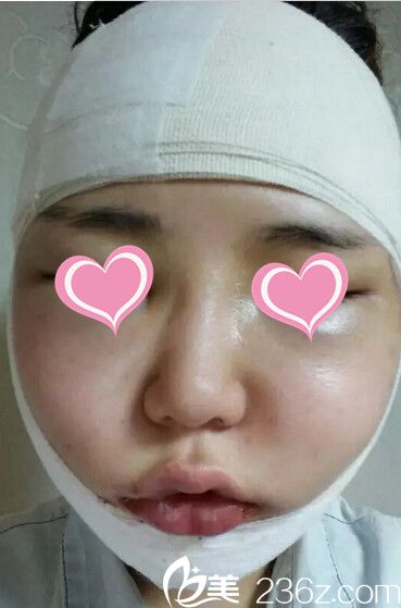 下颌角手术后2天 下颌角手术后2天