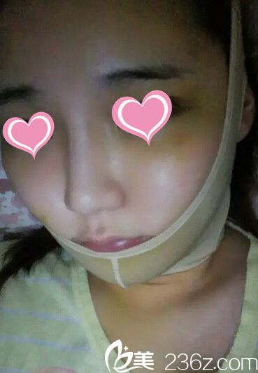 下巴手术后7天 下巴手术后7天