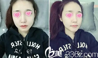 面部轮廓术后20天 面部轮廓术后20天