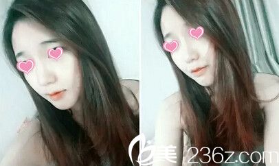 洪政槿院长面部轮廓手术案例 洪政槿院长面部轮廓手术案例