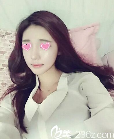艺校妹子在韩国美特乐整形做了下颌角整形、下巴整形、颧骨缩小和面部脂肪填充