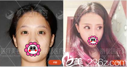 北京米兰柏羽丽都曹卫华韩式双眼皮案例 北京米兰柏羽丽都曹卫华韩式双眼皮案例