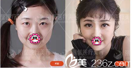 北京米兰柏羽丽都于晓春韩式双眼皮案例 北京米兰柏羽丽都于晓春韩式双眼皮案例