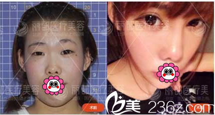 北京米兰柏羽丽都于晓春切开双眼皮开眼角案例 北京米兰柏羽丽都于晓春切开双眼皮开眼角案例