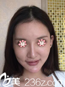 术前老气的我 术前老气的我