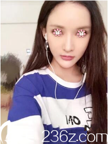 <!--<i data=20240703-sp></i>-->脸部埋线提升术后一个月 <!--<i data=20240703-sp></i>-->脸部埋线提升术后一个月