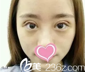 我在大同美神做韩式三点双眼皮术后第3天照片 我在大同美神做韩式三点双眼皮术后第3天照片