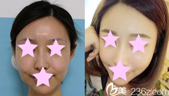 艺雅特整形外科文盛准医生面部填充案例