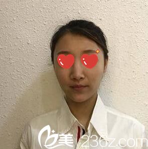 在韩国M整形医院做鼻综合术前照 在韩国M整形医院做鼻综合术前照