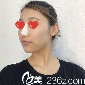 综合立体隆鼻术后天照 综合立体隆鼻术后天照