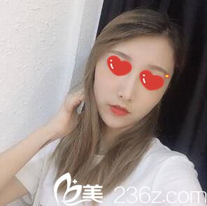 鼻综合整形术后20天恢复效果 鼻综合整形术后20天恢复效果