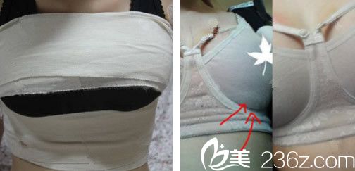 <!--<i data=20240703-sp></i>-->自体脂肪隆胸第4天恢复情况