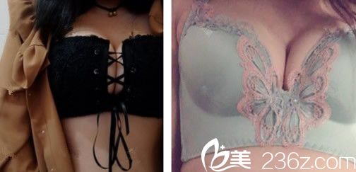 合肥壹加壹自体脂肪丰胸第10天照片