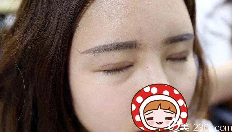 肉条感双眼皮修复一周后恢复