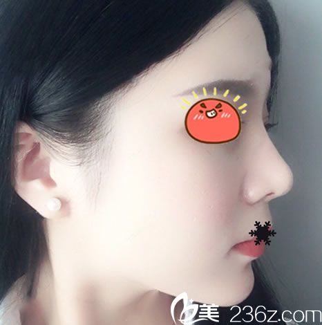 当我把想去金华亚美找邓泽臣做鼻综合隆鼻的想法告诉男友后,他居然同意了还主动掏钱