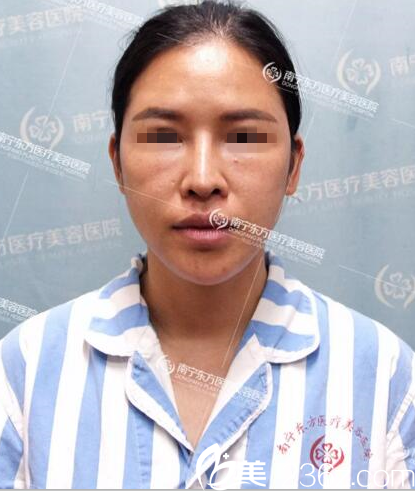 在南宁东方做鼻修复手术前 在南宁东方做鼻修复手术前