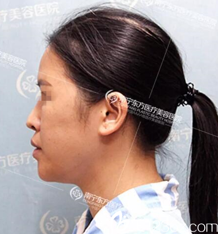 在南宁东方做鼻修复手术侧面照 在南宁东方做鼻修复手术侧面照