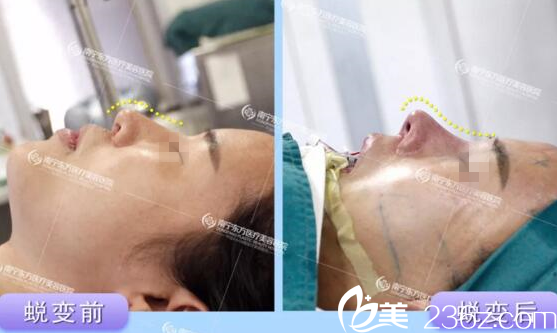 在南宁东方做鼻修复手术当天 在南宁东方做鼻修复手术当天