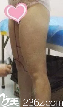 术前大腿粗壮 术前大腿粗壮