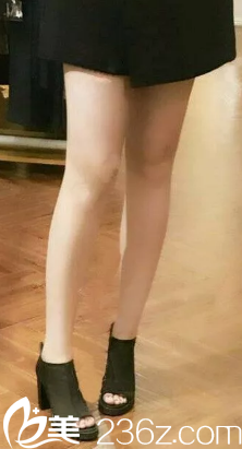 大腿吸脂20天腿部完全消肿 大腿吸脂20天腿部完全消肿