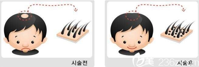韩国延世毛百丽植发毛发移植优势 韩国延世毛百丽植发毛发移植优势