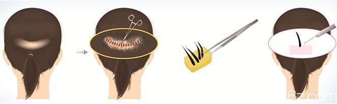 韩国延世毛百丽植发毛发移植技术特点 韩国延世毛百丽植发毛发移植技术特点